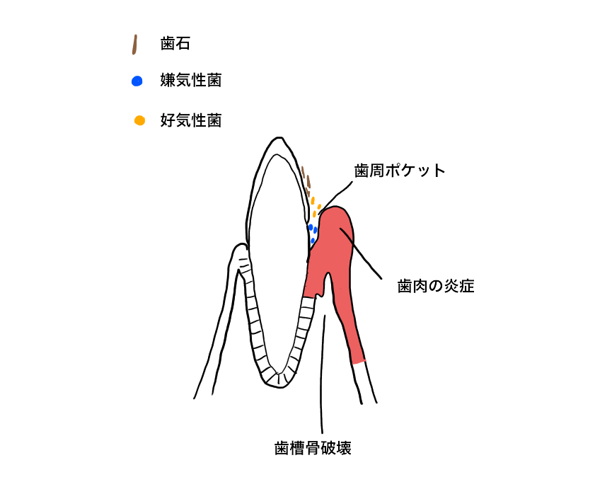 歯周炎を起こしている歯